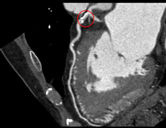 Afbeelding CT-scan van het hart